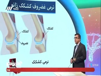 آیا نرمی غضروف کشکک زانو قابل درمان است؟