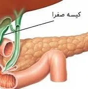 مراقبت‌های پس از جراحی کیسه صفرا