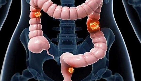افزایش نرخ سرطان روده بزرگ در میان جوانان در سراسر جهان