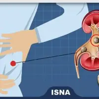 اینفوگرافی/ چطور از ایجاد سنگ کلیه پیشگیری کنیم؟