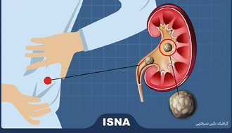 اینفوگرافی/ چطور از ایجاد سنگ کلیه پیشگیری کنیم؟