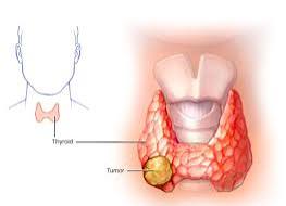 اگر کیست تیروئید خونی باشد، خطری ندارد