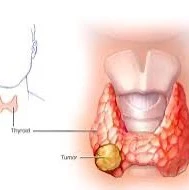   اگر کیست تیروئید خونی باشد، خطری ندارد