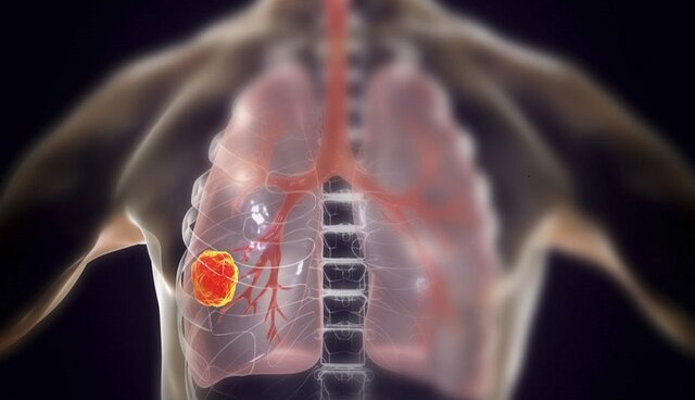 یافتن راهکاری برای کاهش مرگ و میر در سرطان ریه ‏