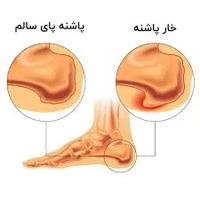 مهم‌ترین علت بروز خار پاشنه