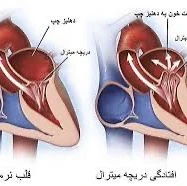 چه زمانی افتادگی دریچه میترال خطرناک است؟