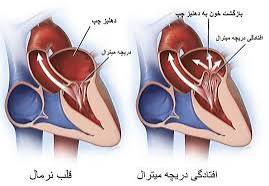 چه زمانی افتادگی دریچه میترال خطرناک است؟