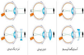 آشنایی با انواع عیوب انکساری چشم