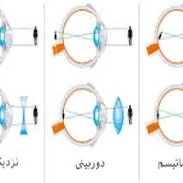 آشنایی با انواع عیوب انکساری چشم