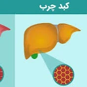 ارتباط بین دفع پروتئین و کبد چرب