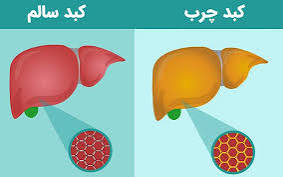 ارتباط بین دفع پروتئین و کبد چرب