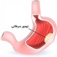 عوامل موثر در بروز سرطان معده