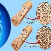 چه زمانی مصرف کورتون سبب پوکی استخوان میشود؟ 