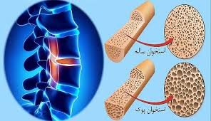 چه زمانی مصرف کورتون سبب پوکی استخوان میشود؟