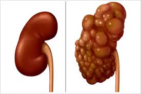 کیست‌های کلیه چه زمانی خطرناک هستند؟ 