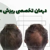 خبر فوری: دانشمند یزدی فرمول گیاهی درمان ریزش مو را کشف کرد!