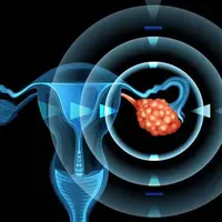 چگونه میتوان از پیشرفت سرطان تخمدان جلوگیری کرد؟