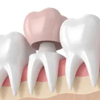 آنچه از روکش دندان و انواع آن باید بدانید