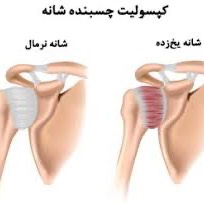 چگونه تشخیص دهیم دچار شانه یخ زده شده‌ایم؟