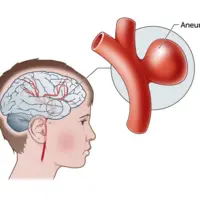 چه کسانی دچار آنوریسم مغزی می شوند؟