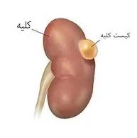 نکاتی در مورد کیست های کلیوی