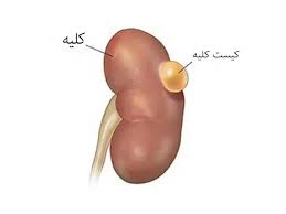 نکاتی در مورد کیست های کلیوی