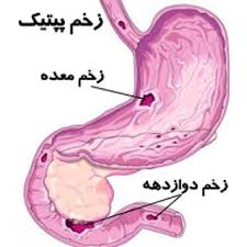 مطمئن ترین روش برای تشخیص زخم معده چیست؟