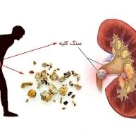 سنگ کلیه؛ طاقت فرساترین درد دنیا