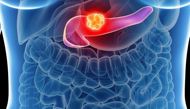 سرطان پانکراس در موش‌ها با کمک فناوری‌نانو بهبود امیدوارکننده‌ای یافت