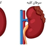 علائم اصلی تومور کلیه چیست؟ 