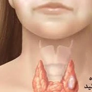 عوامل موثر در ایجاد گره‌های تیروئیدی