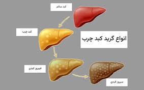 نوشیدن آب سرد باعث کبد چرب می‌شود؟