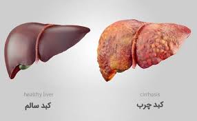 مهم‌ترین علائم کبد چرب