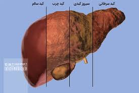 باورهای غلط در مورد کبد چرب