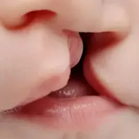 از هر ۱۰۰۰ تولد ۴ نوزاد با شکاف لب متولد می‌شوند