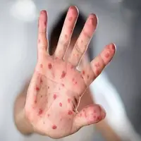 ثبت ۴ مورد ابتلا به سرخک در یزد