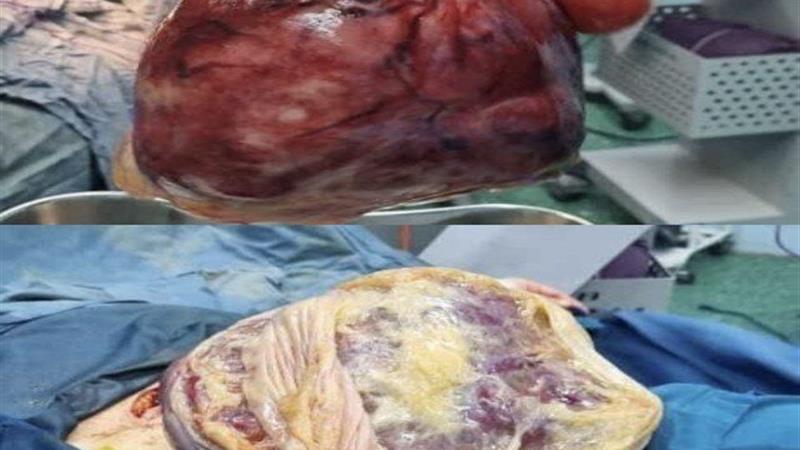 نجات مادر سنندجی از توده ۵ کیلویی
