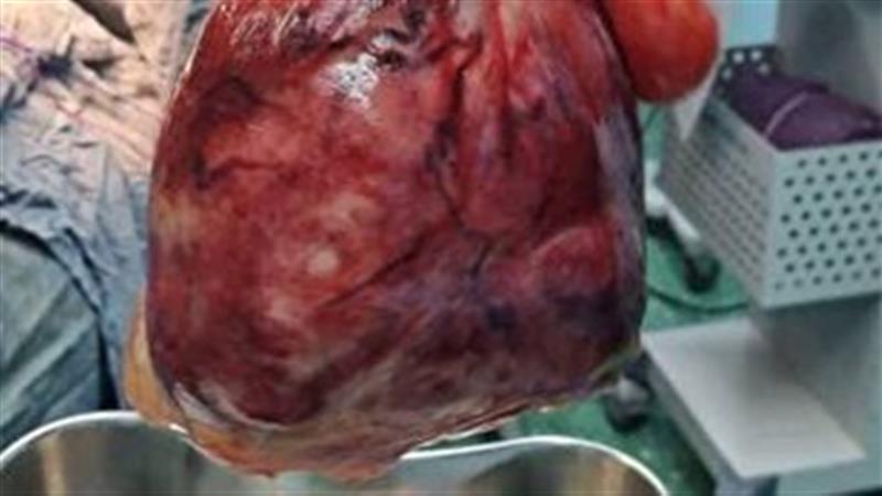 خارج کردن توده ۵ کیلویی از شکم خانم ۴۲ ساله در سنندج