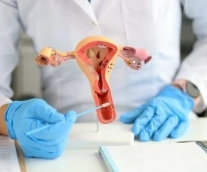 سندروم تخمدان پلی کیستیک را چگونه می‌توان تشخیص داد؟