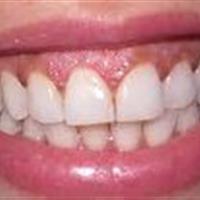 تغذیه مفید برای لثه و دهان