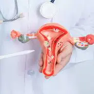 مهم ترین علامت در تشخیص سندروم تخمدان پلی کیستیک چیست؟ 