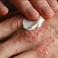 تغییر فصل، محرک اگزما نه عامل ایجاد آن