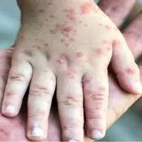 ابتلای هزار نفر در ایران به یک بیماری مسری خطرناک