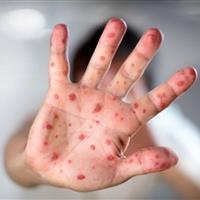3 عامل بروز سرخک در ایران/شیوع بیماری تحت کنترل است