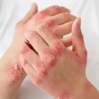 واقعیت پزشکی درباره بیماری مزمن پسوریازیس