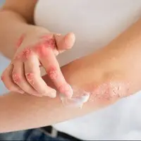 اگزما از کجا می‌آید و چطور می‌شود مهارش کرد؟