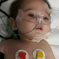 تراژدی نوزادان ناقص‌الخلقه در غزه؛ کودکی که بدون مغز متولد شد