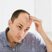 چند باور نادرست درباره ریزش مو
