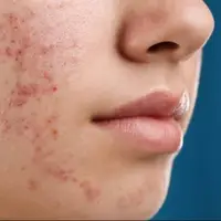 آکنه در بزرگسالی خطر ابتلا به اختلالات خوردن را افزایش می‌دهد