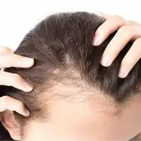 قطع مصرف ماینوکسیدیل ریزش موها را بدتر می‌کند؟